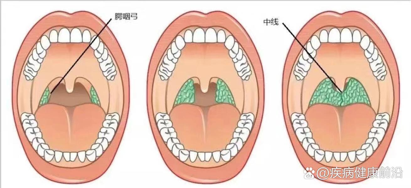 扁桃体肿大图解图片