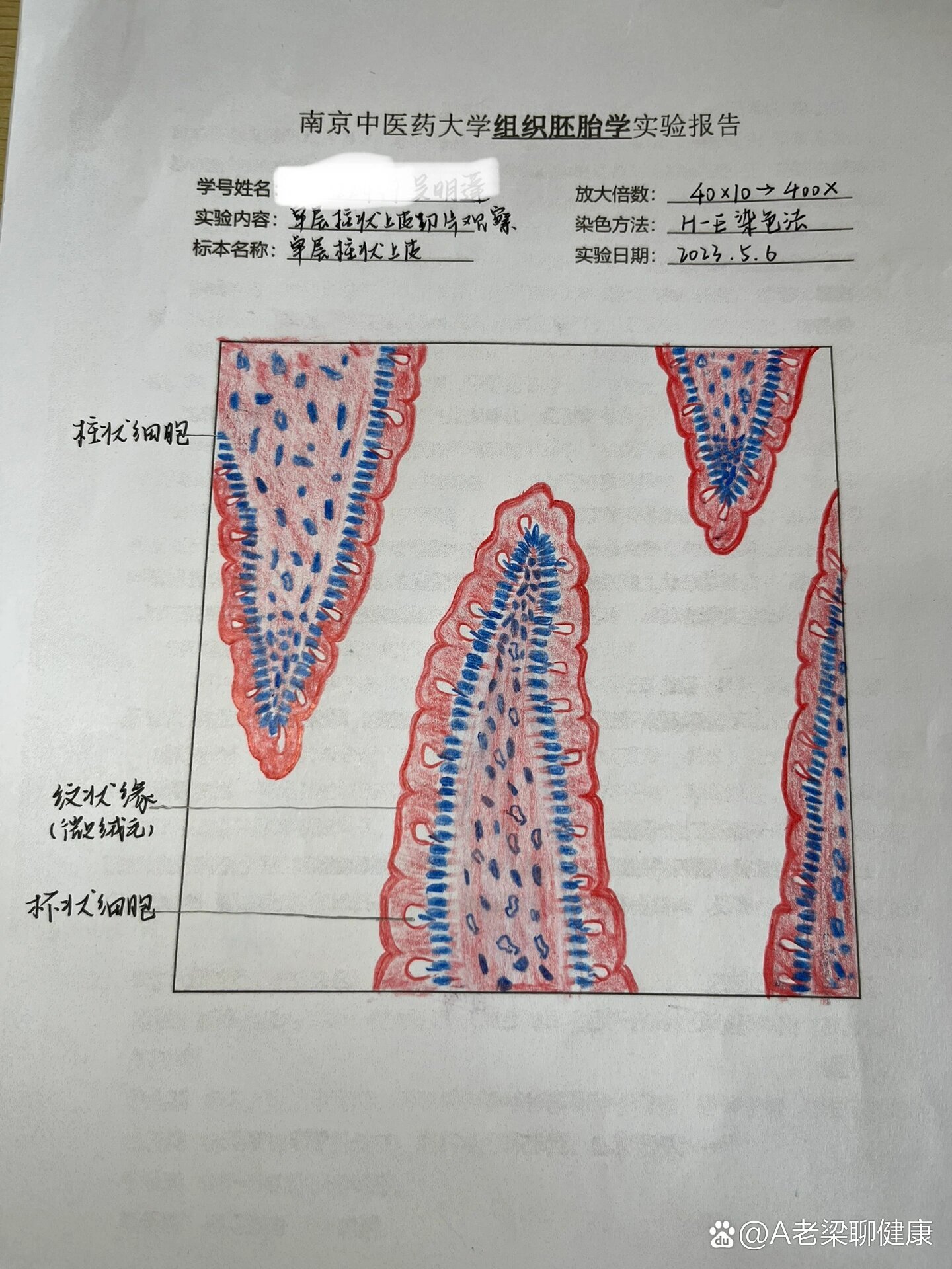 肾浊肿手绘实验报告图图片