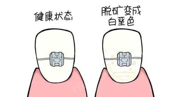 牙齿脱矿的原因有哪些