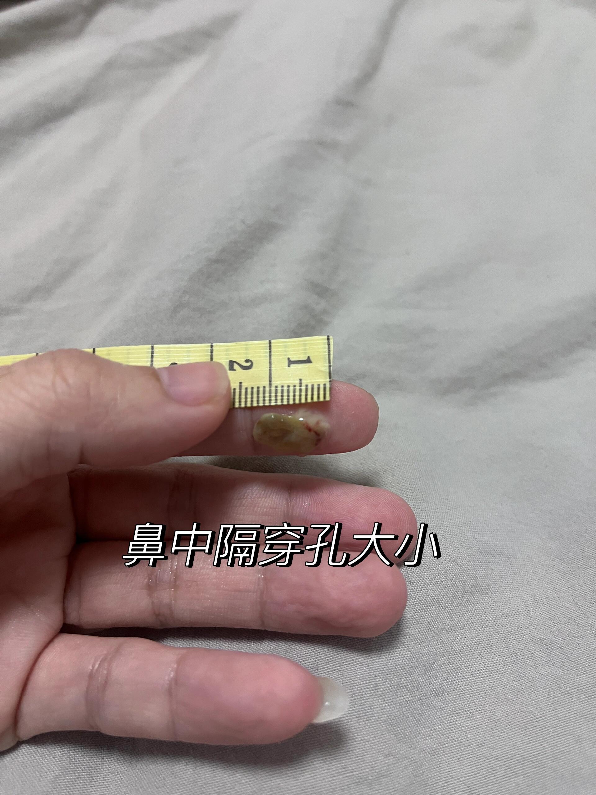 鼻中隔穿孔的大小