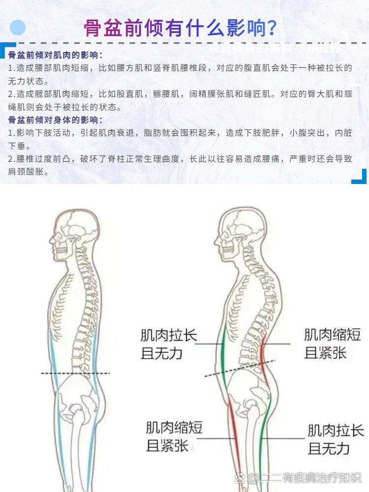 骨盆前倾男性图片