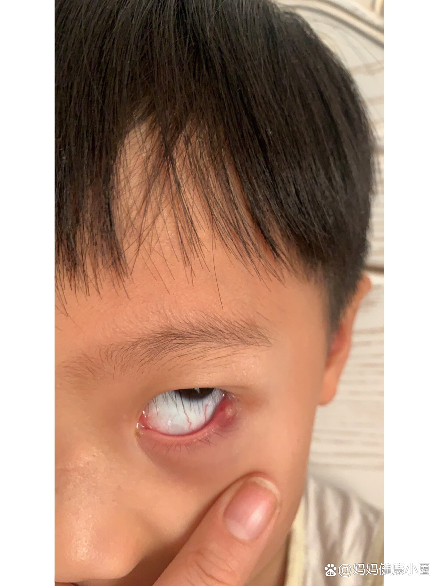 我家宝贝睡一觉眼睛红肿