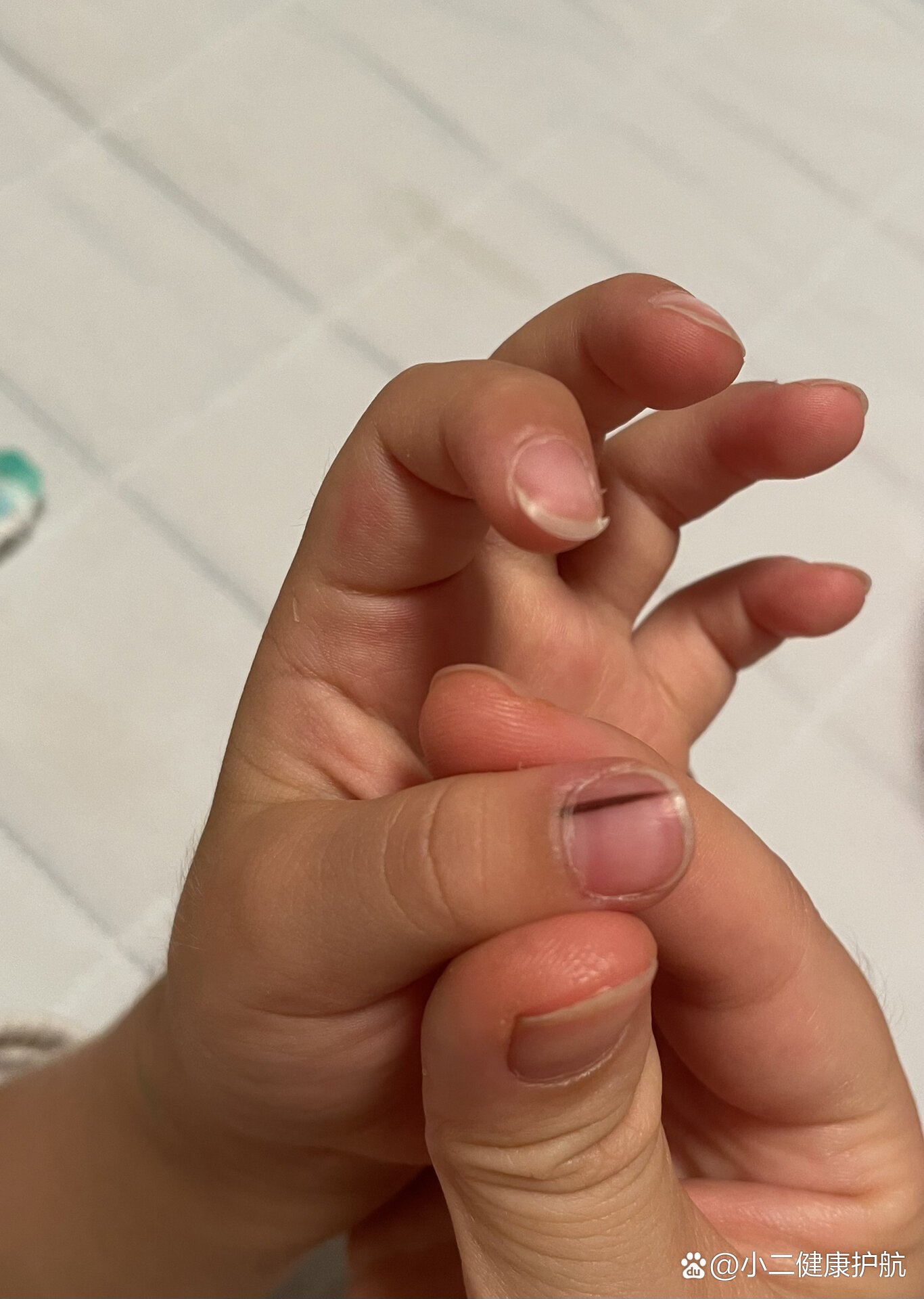关于甲母痣,我有点经验分享下