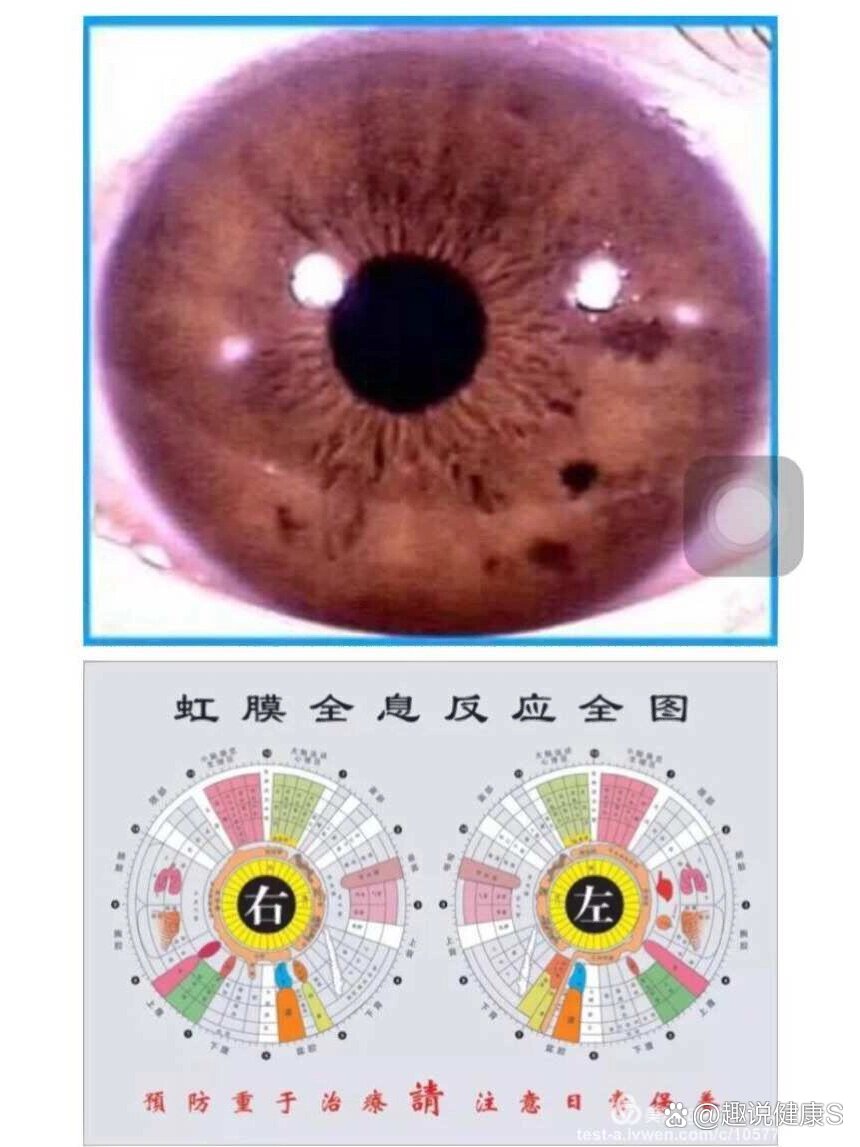 健康虹膜图片对比图片