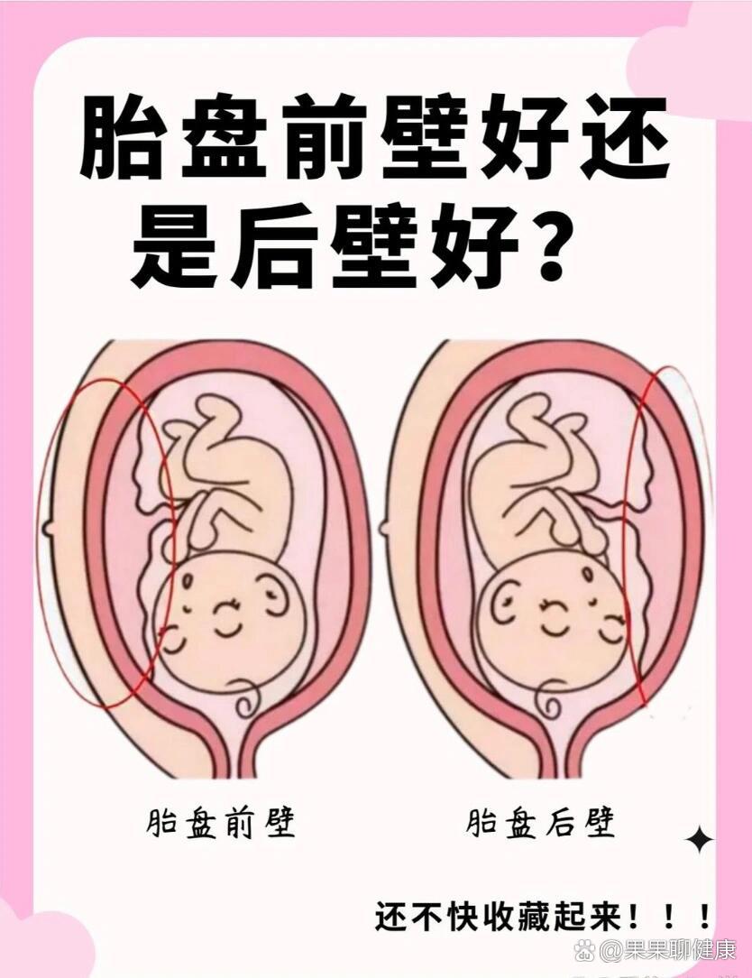 胎盘前壁好还是后壁好?