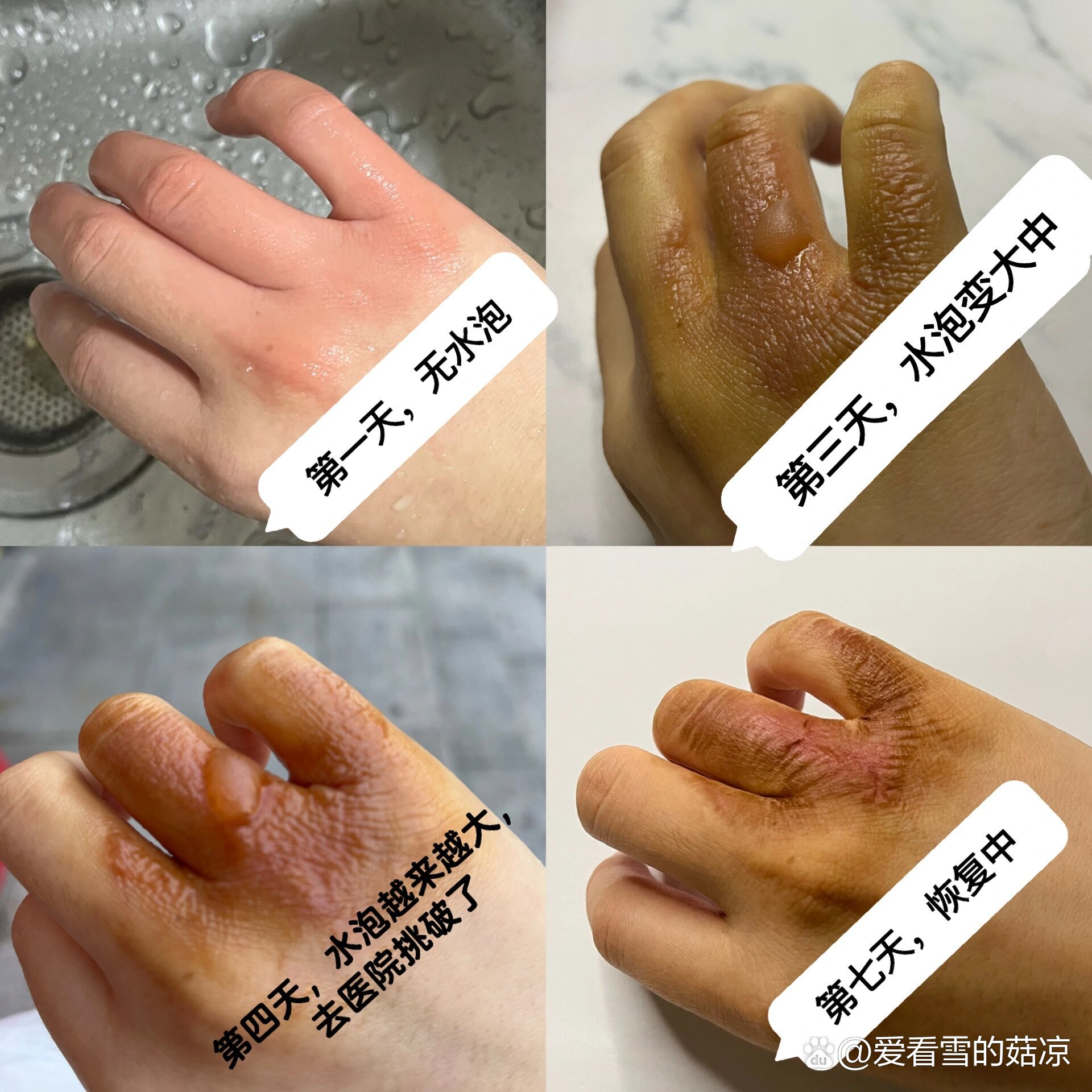 烫伤后的小妙招图片