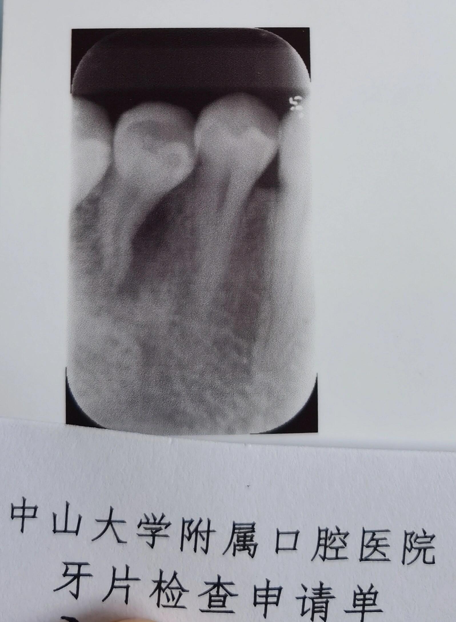 慢性牙根尖炎症状图片图片