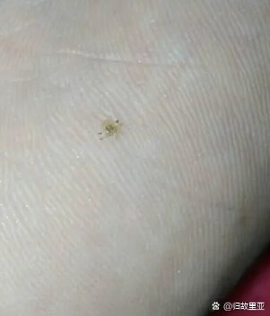  br>阴虱病是一种传染性的寄生虫感染性疾病.