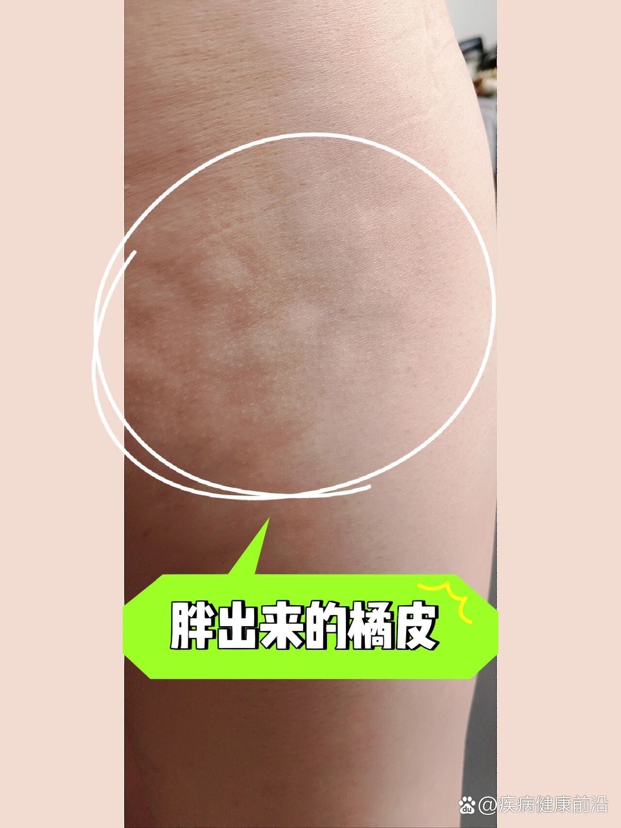 大腿屁股坑坑洼洼-胖了会有丑丑的橘皮组织