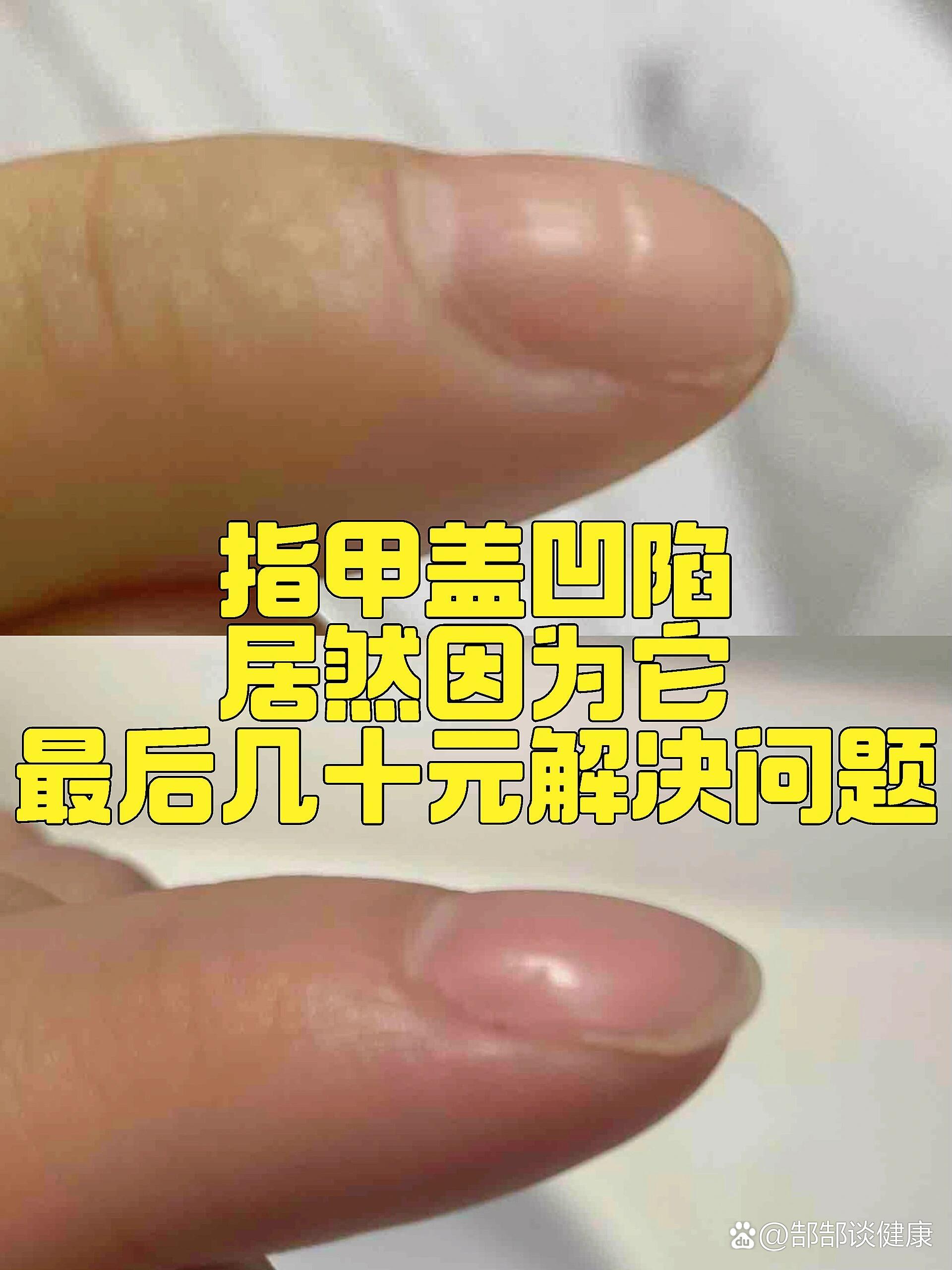 指甲缺钙的症状图片