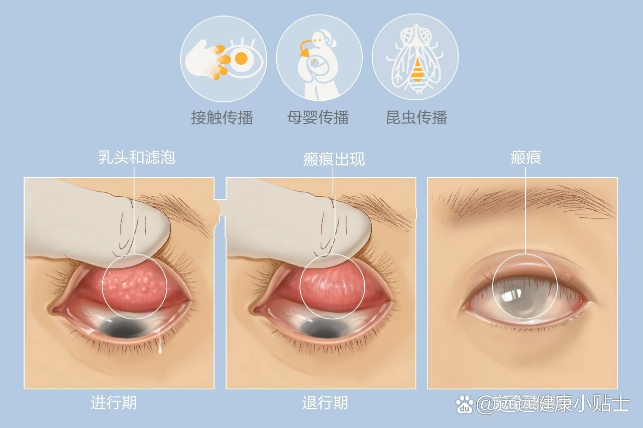 下眼睑结膜滤泡图片