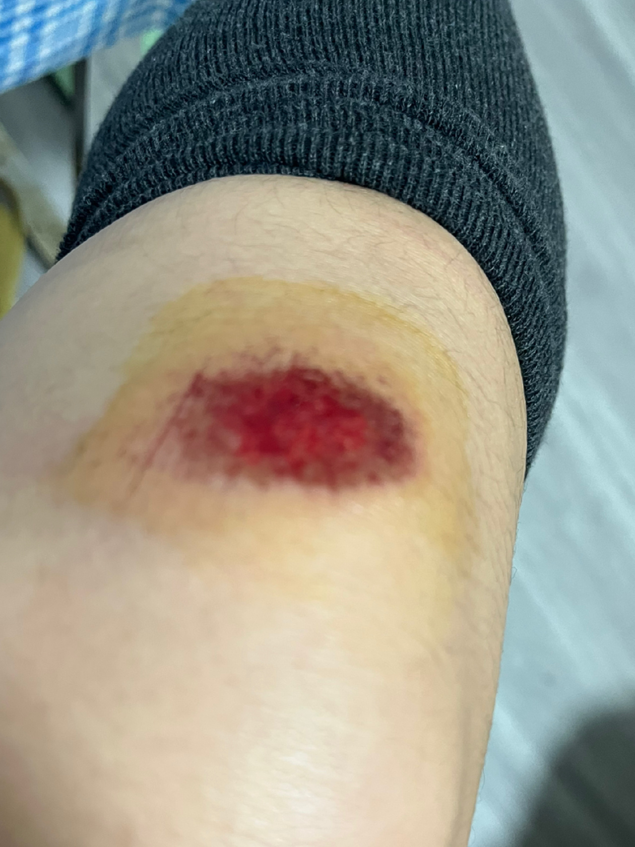 腿摔伤了求好用的治疗方法😭
