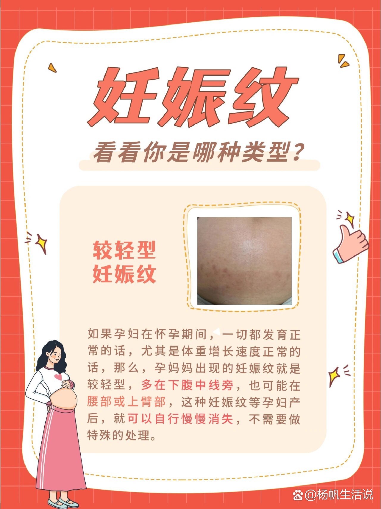 妊娠纹‼️看看你是哪种类型❓