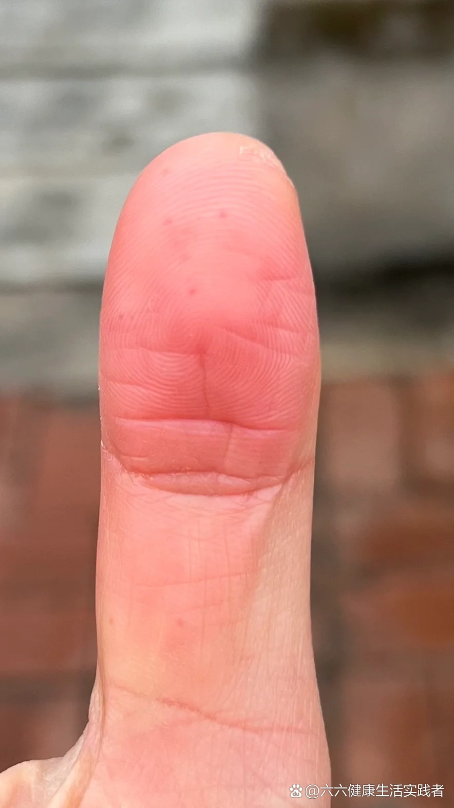 手指上莫名其妙长出这个像被针扎过一样的小红点,碰到会痛,有点凸出
