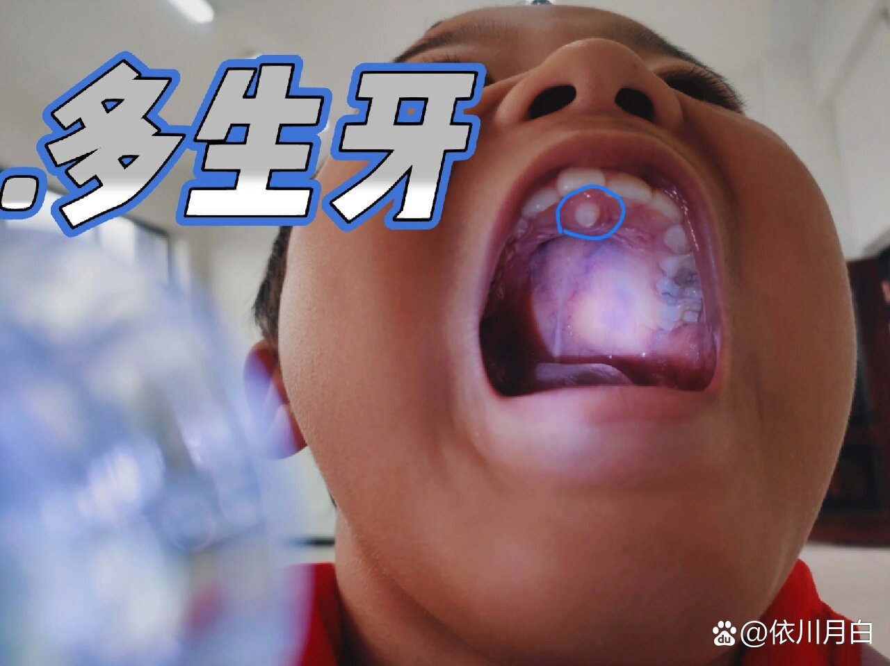 多生牙一点要重视