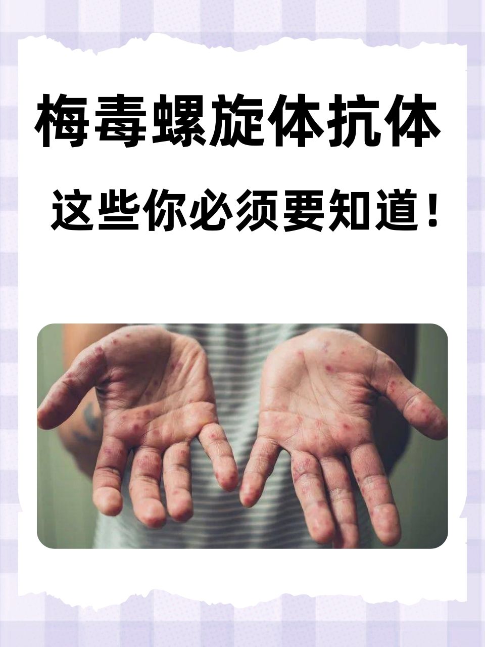 梅毒螺旋体抗体:这些你必须要知道!