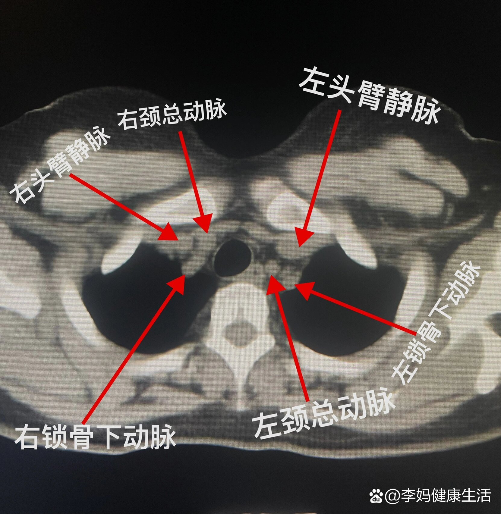 前纵膈解剖位置图片