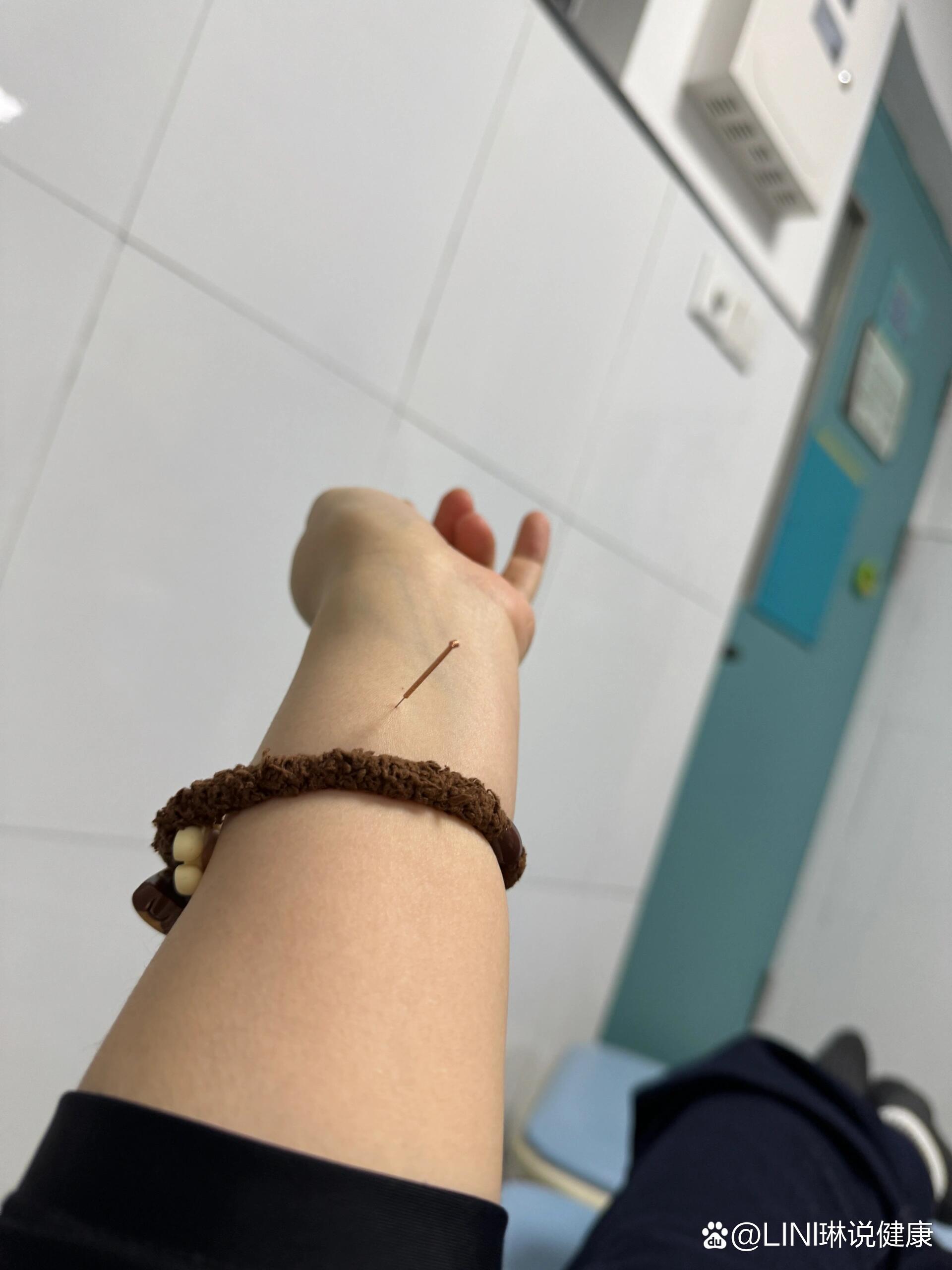 失眠怎么办,针灸体验一下