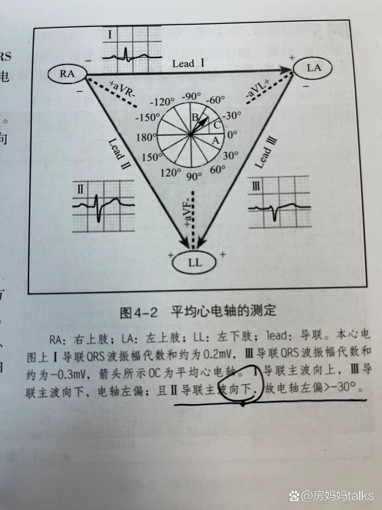 心电轴右偏心电图表现图片