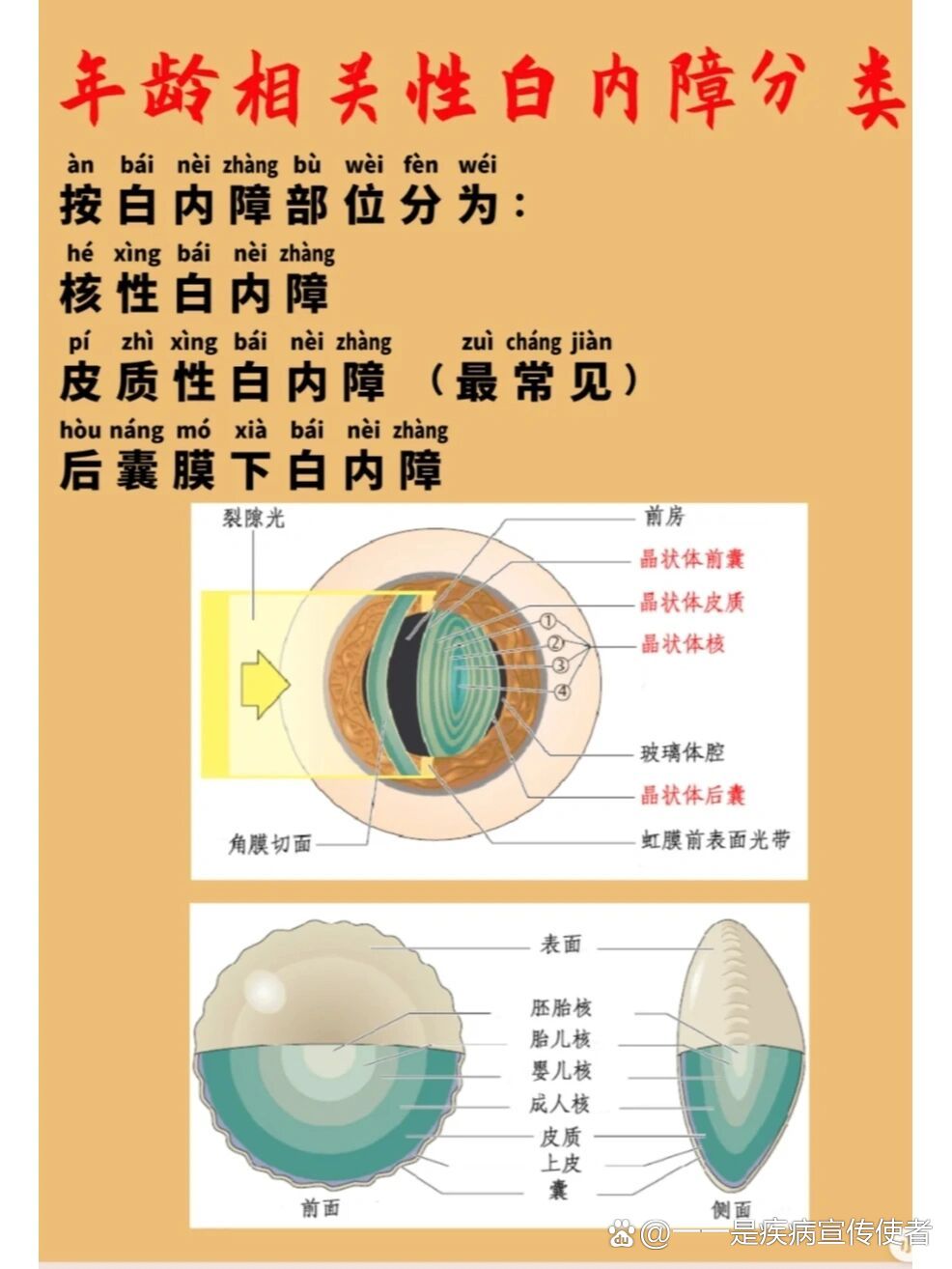 白内障四期分类图片图片