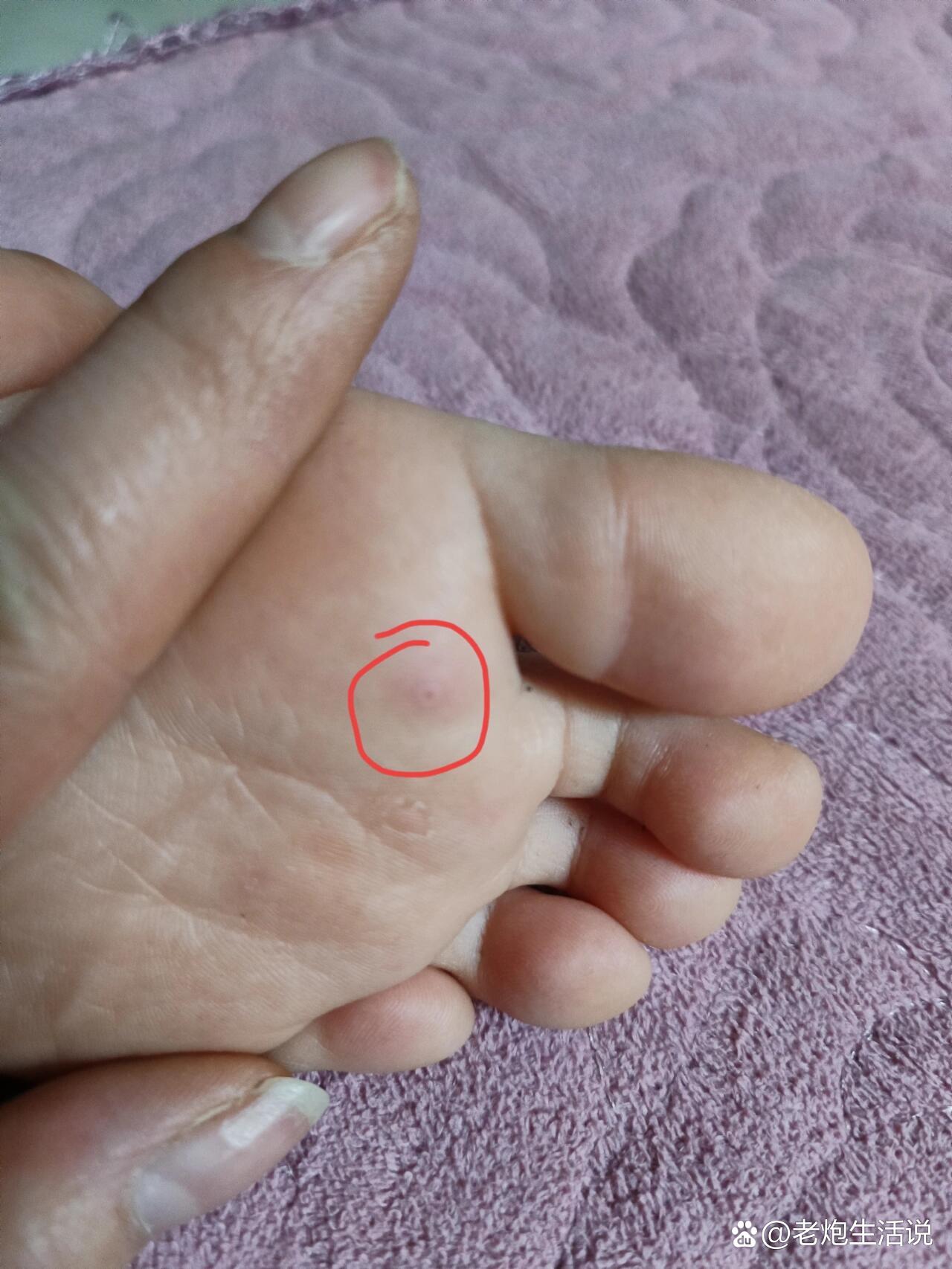 鸡眼是长这样吗