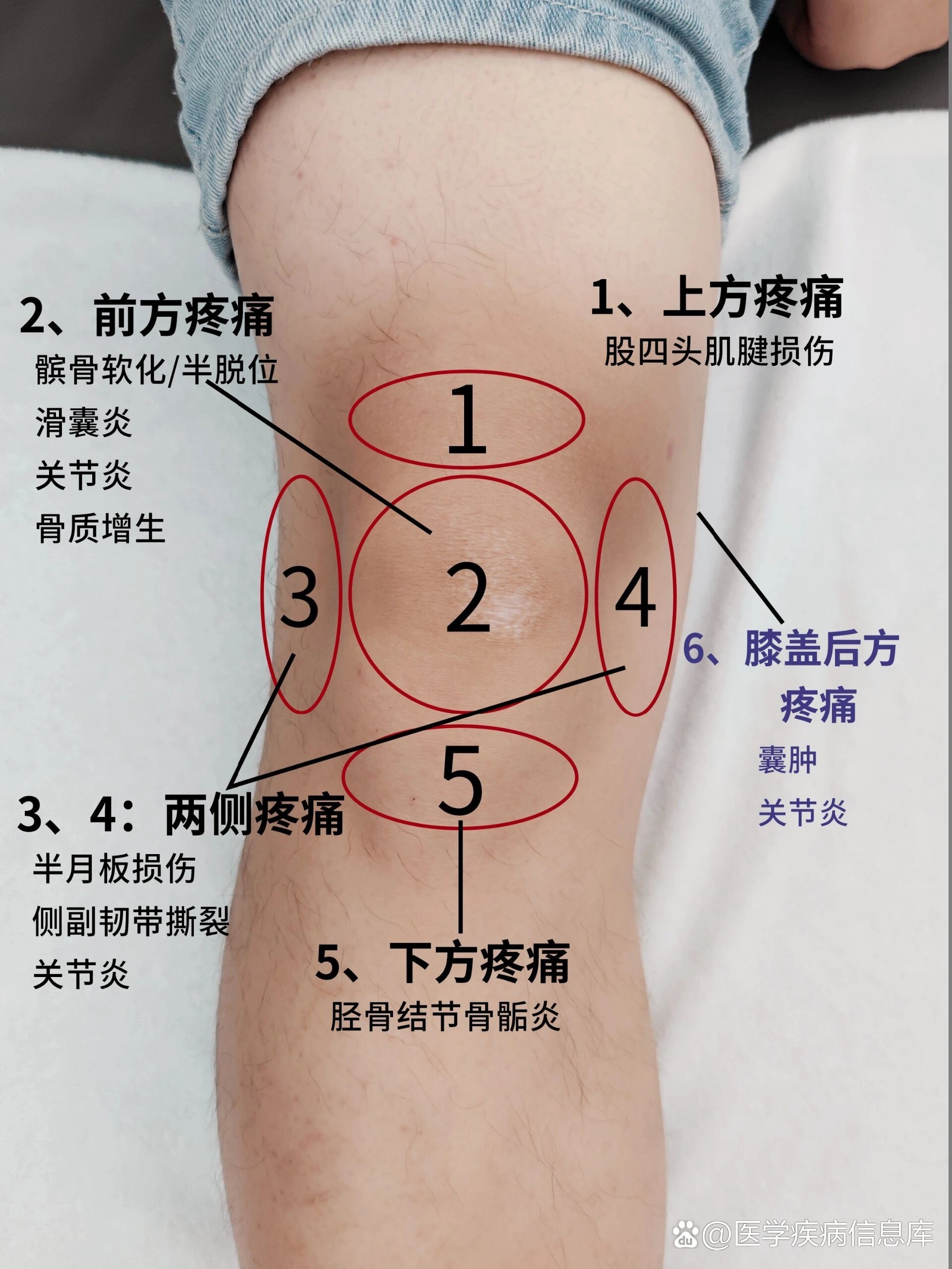 膝盖疼无非就是四大问题
