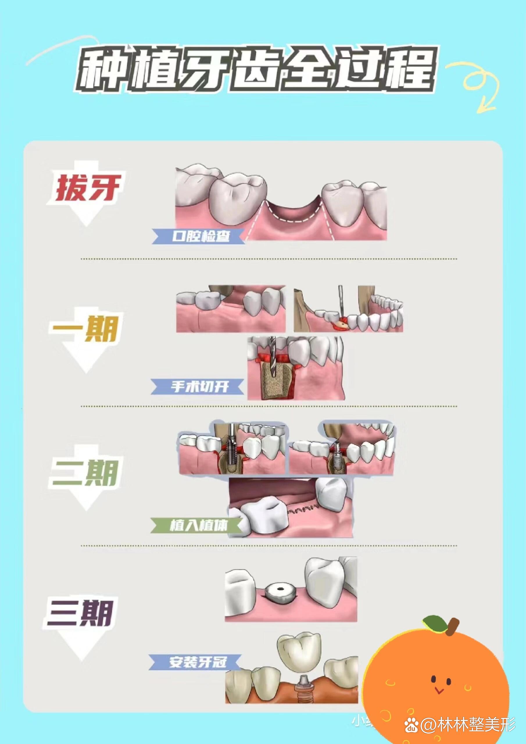 种植牙过程