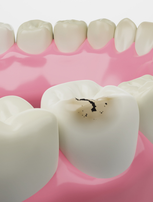 你看到的牙齿表面黑线,其实里面全黑了!