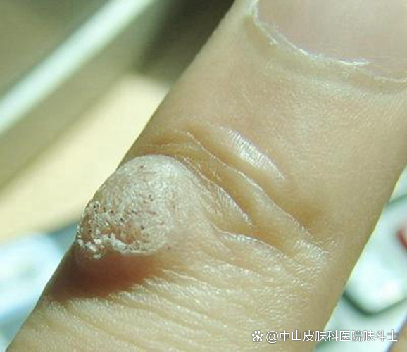 手部寻常疣的祛除方法有哪些?