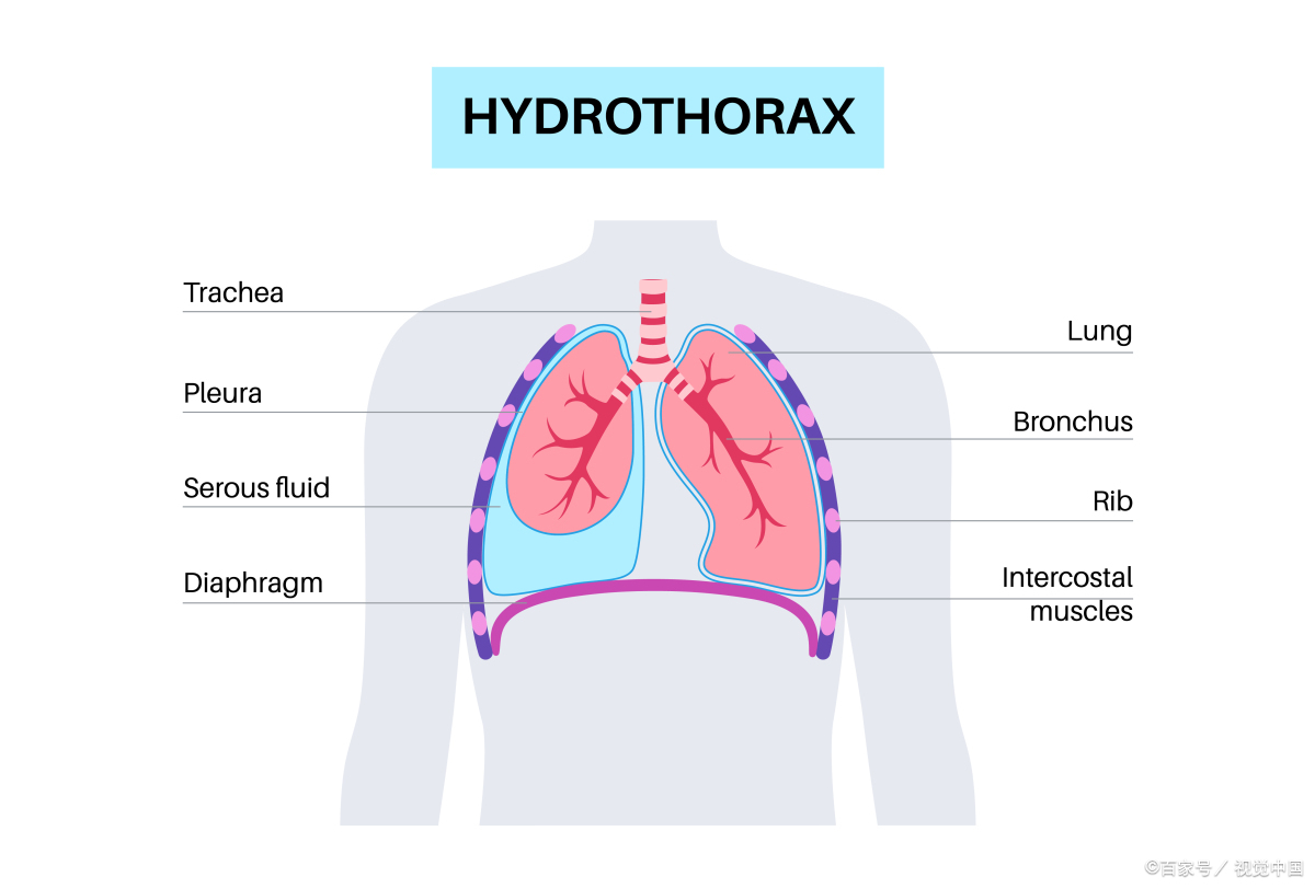 胸腔积液9厘米严重吗？
