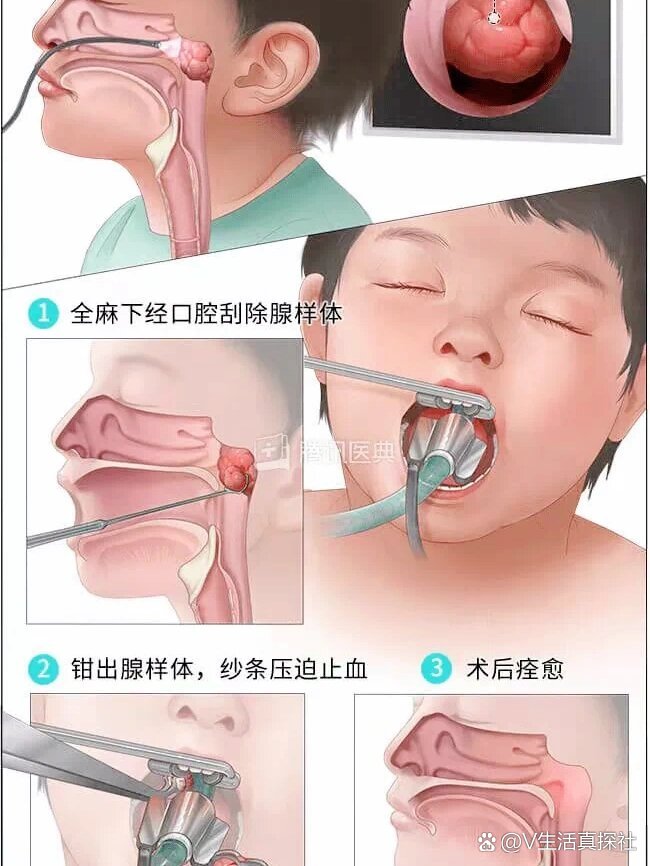扁桃体腺样体切除手术之后