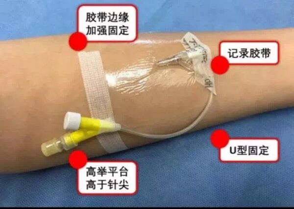  br>1,留置针留置期间,穿刺一侧的手臂可以适当的活动,防止用力过度