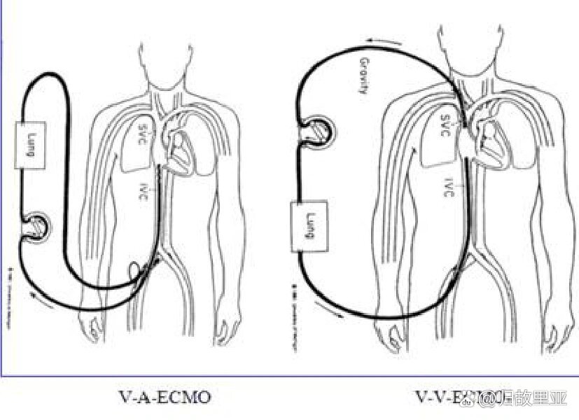 ecmo原理图解图片
