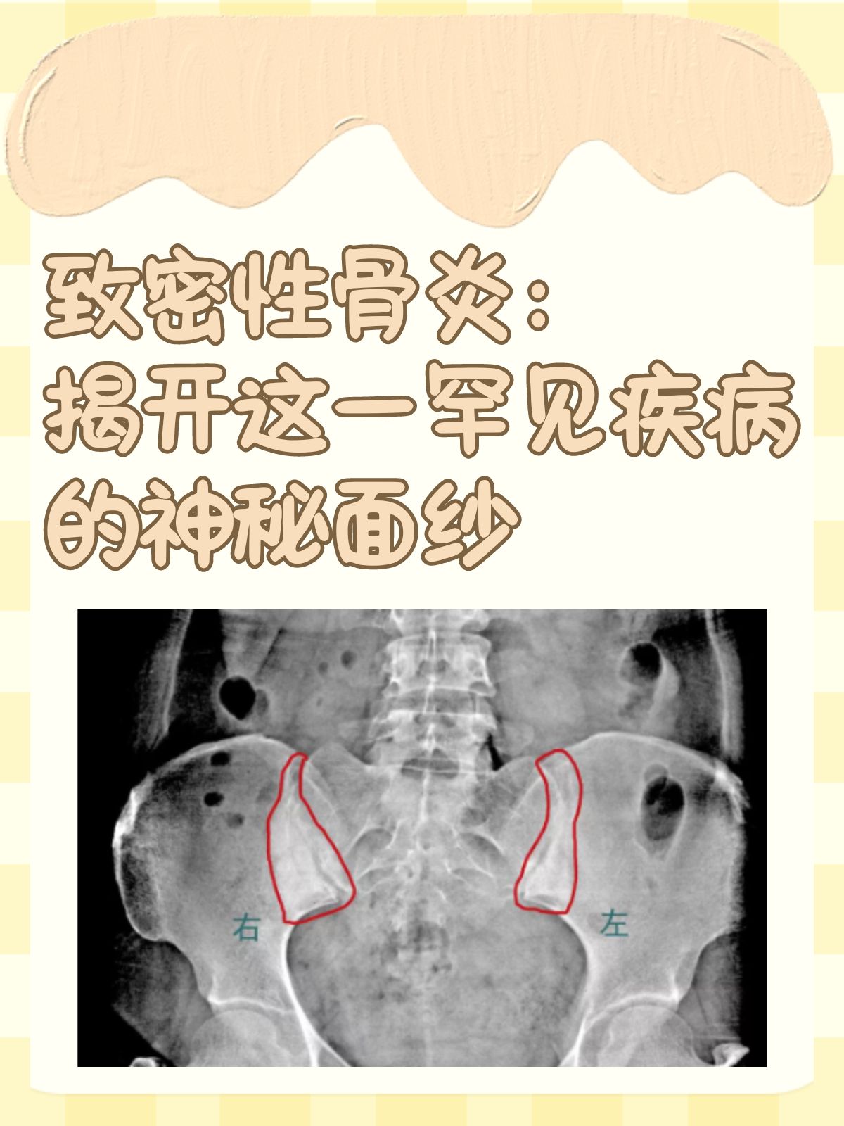 下颌骨致密性骨炎图片图片