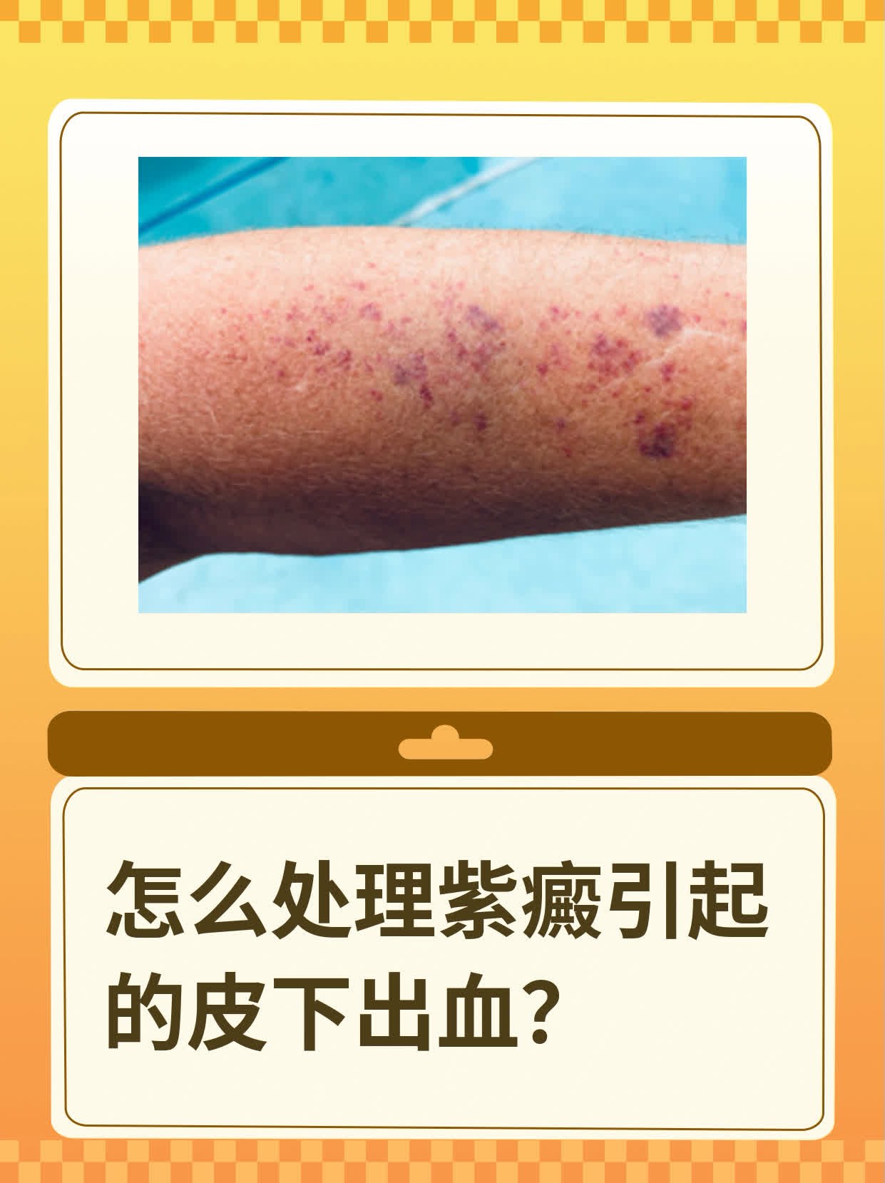 怎么处理紫癜引起的皮下出血