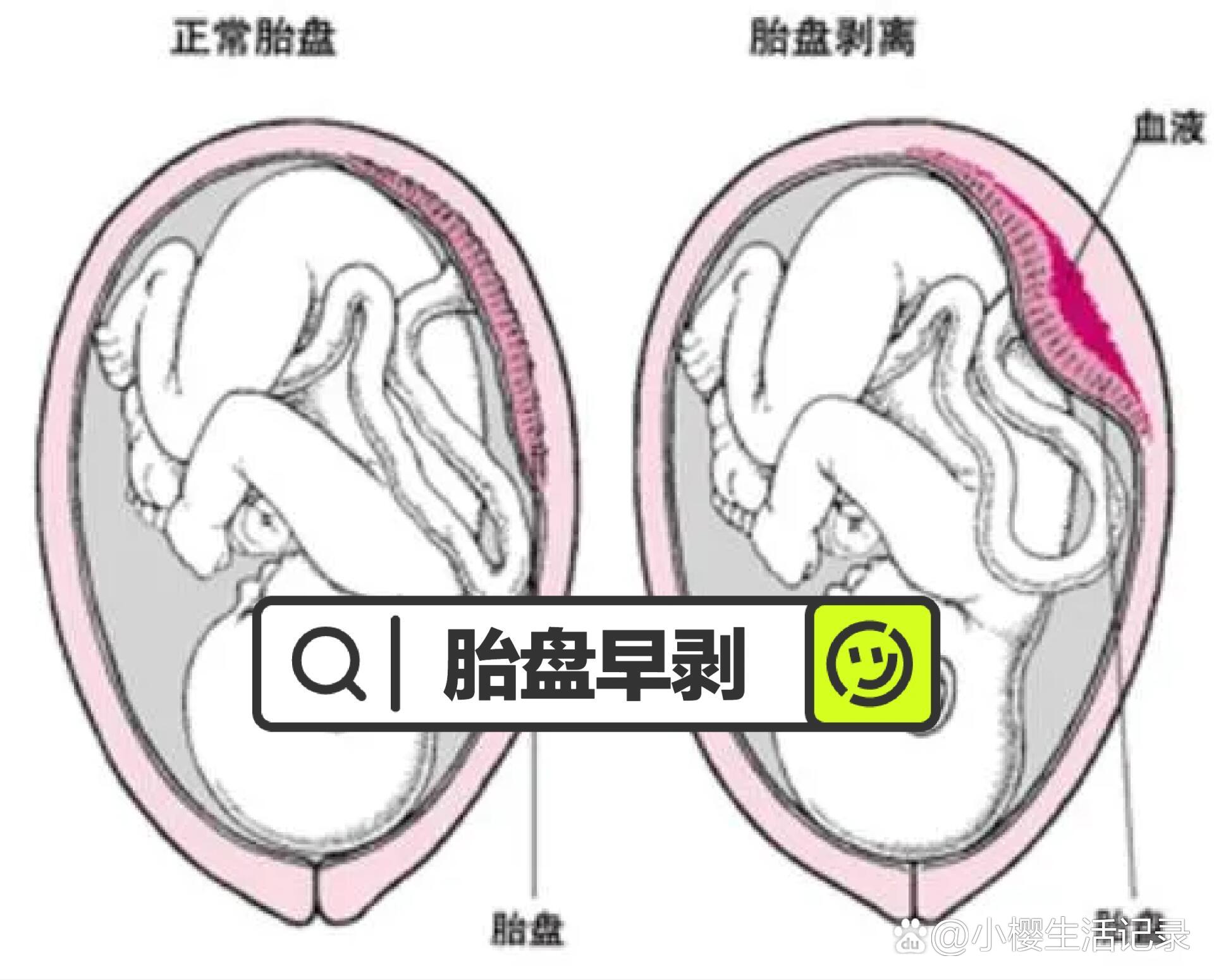 前置胎盘胎盘早剥图片