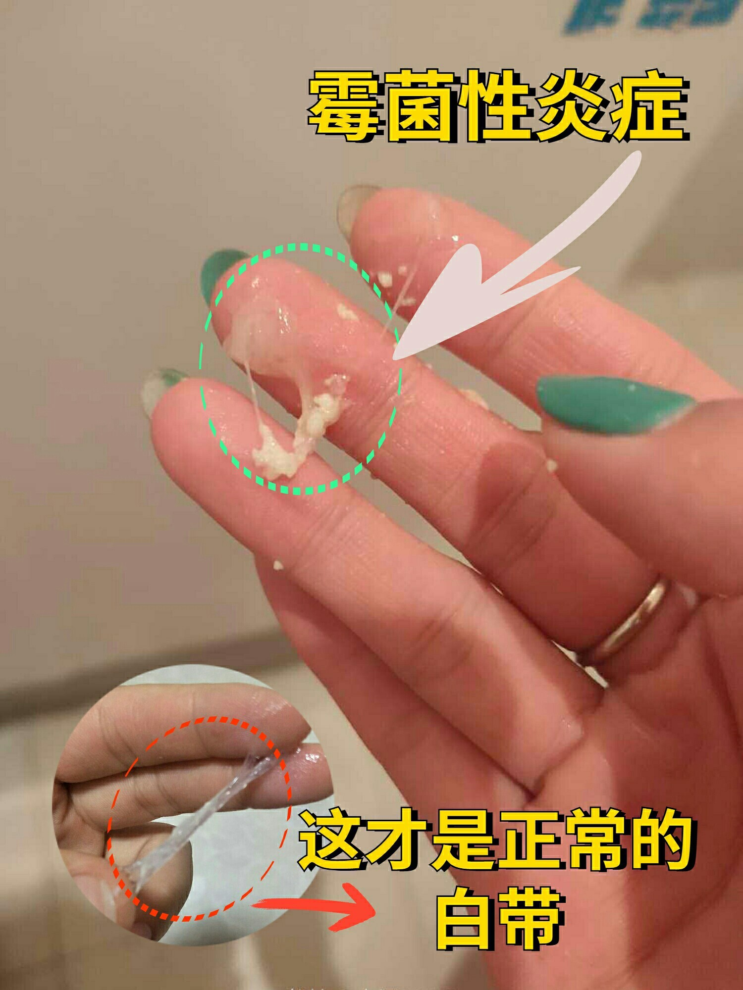 白带出现这些情况,可一定要注意了😖其实现在很多妇科炎症的