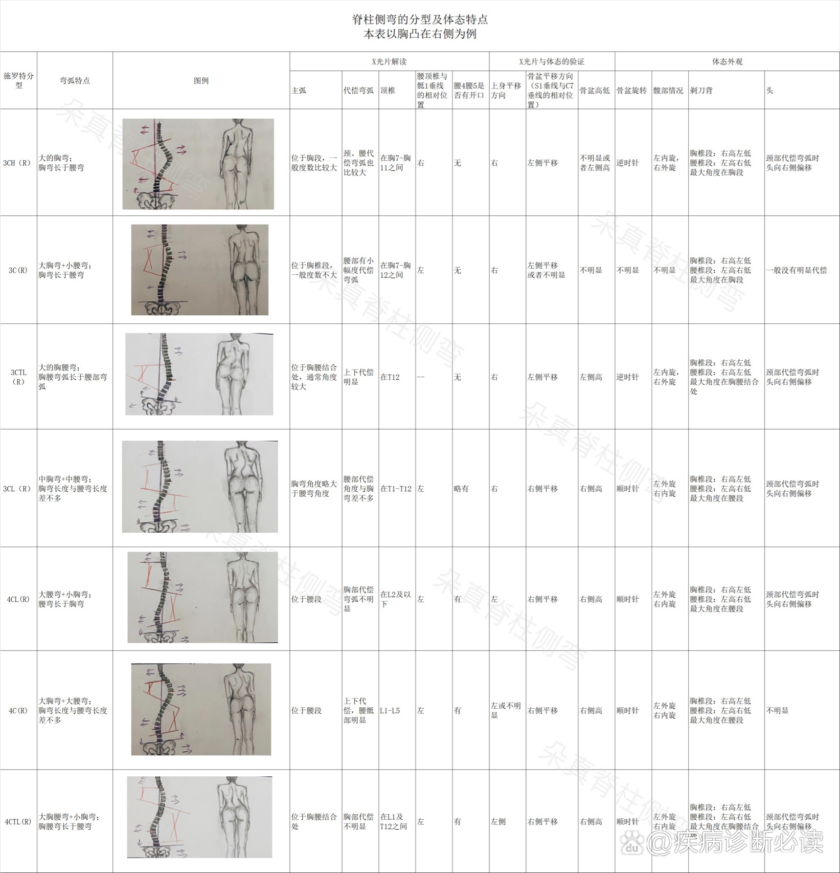 脊柱侧弯lenke分型图谱图片