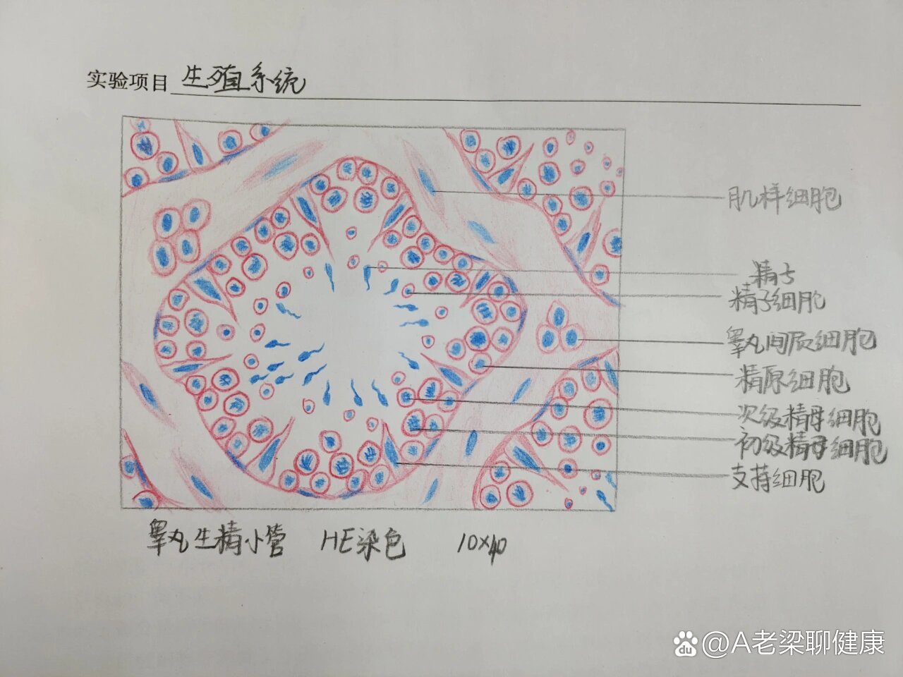 葡萄胎红蓝铅笔图图片