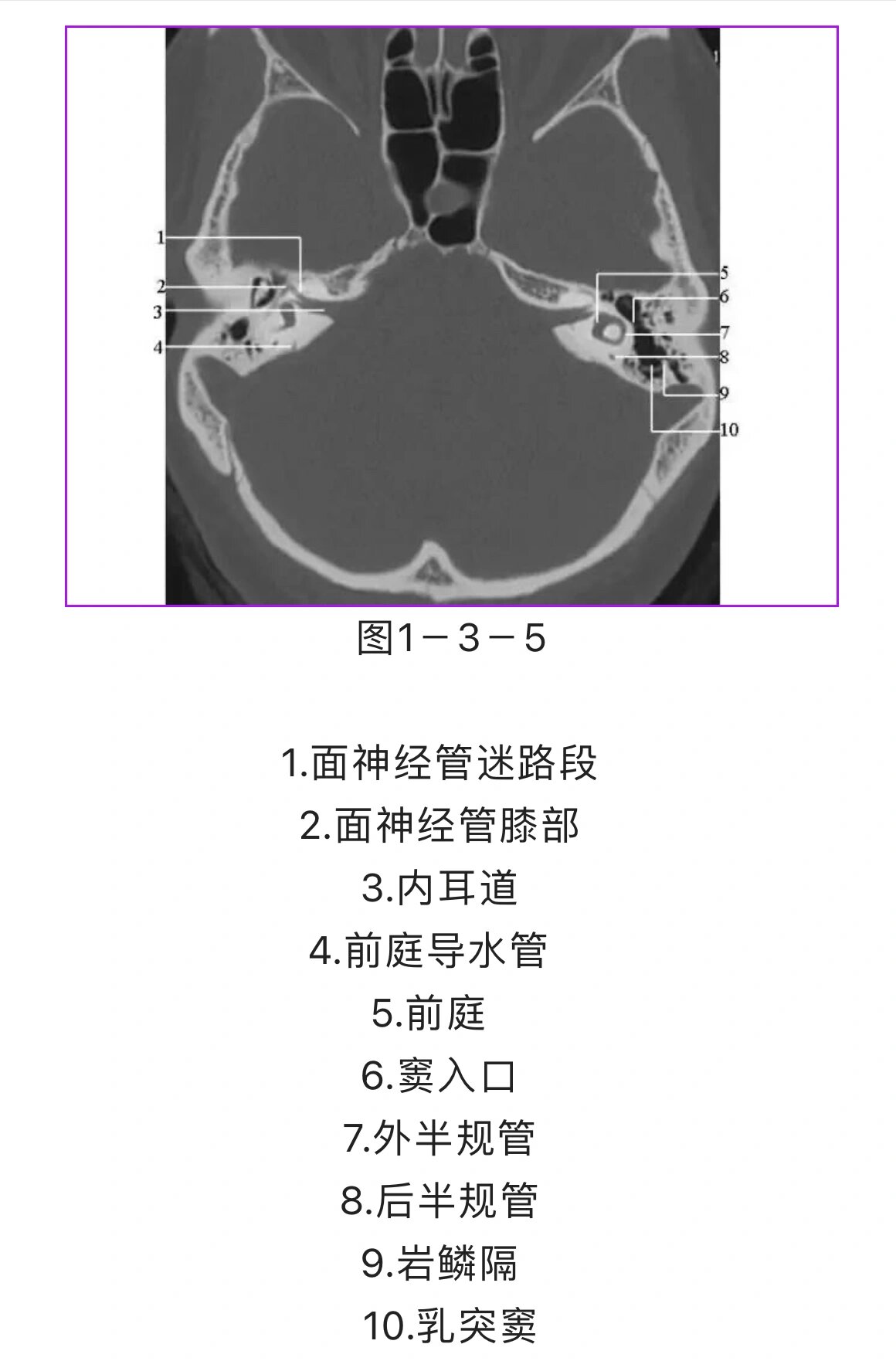 影像学干货|颞骨ct解剖(轴位)