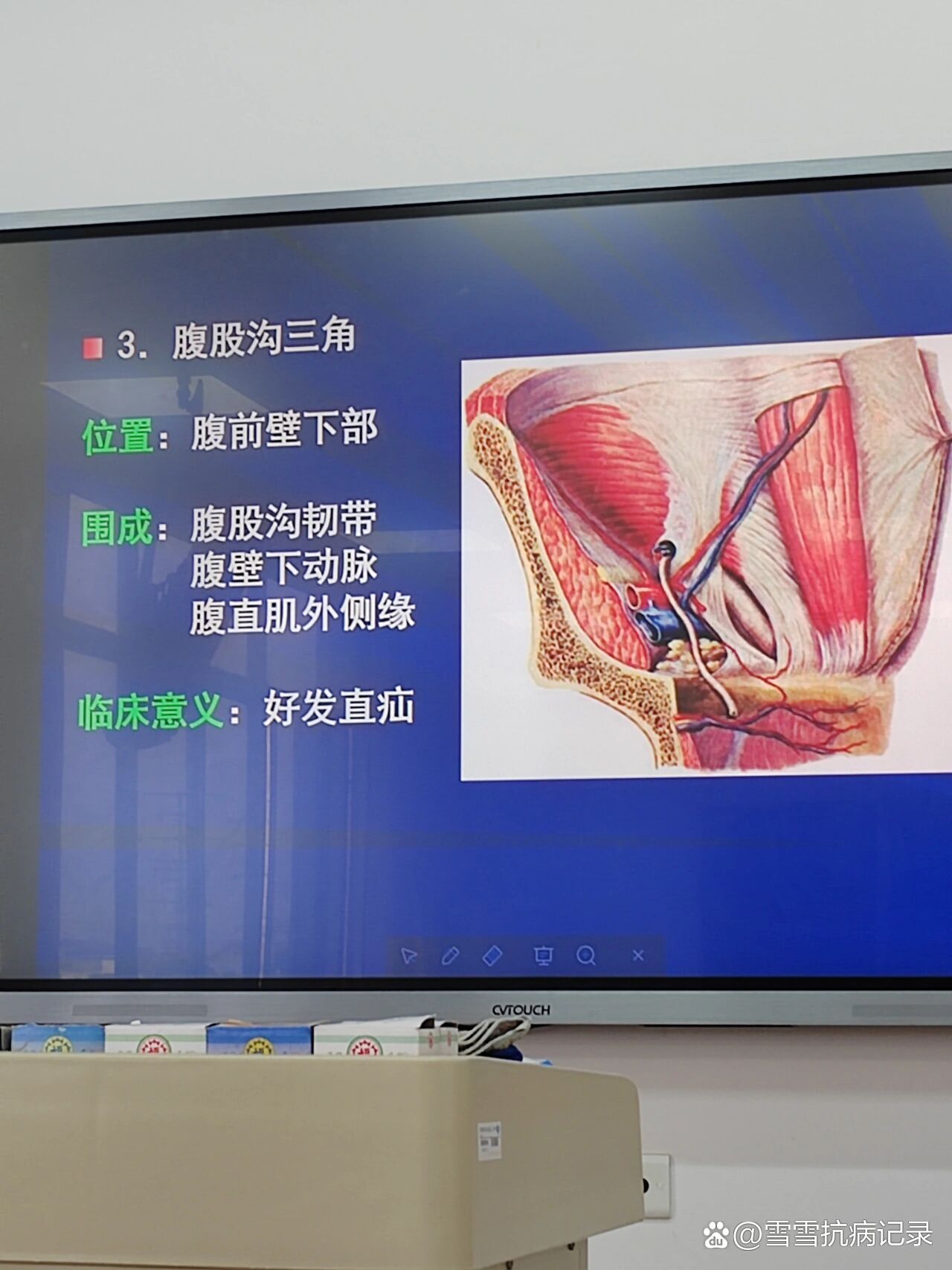 腹股沟区三角形示意图,腹股沟三角_大山谷图库