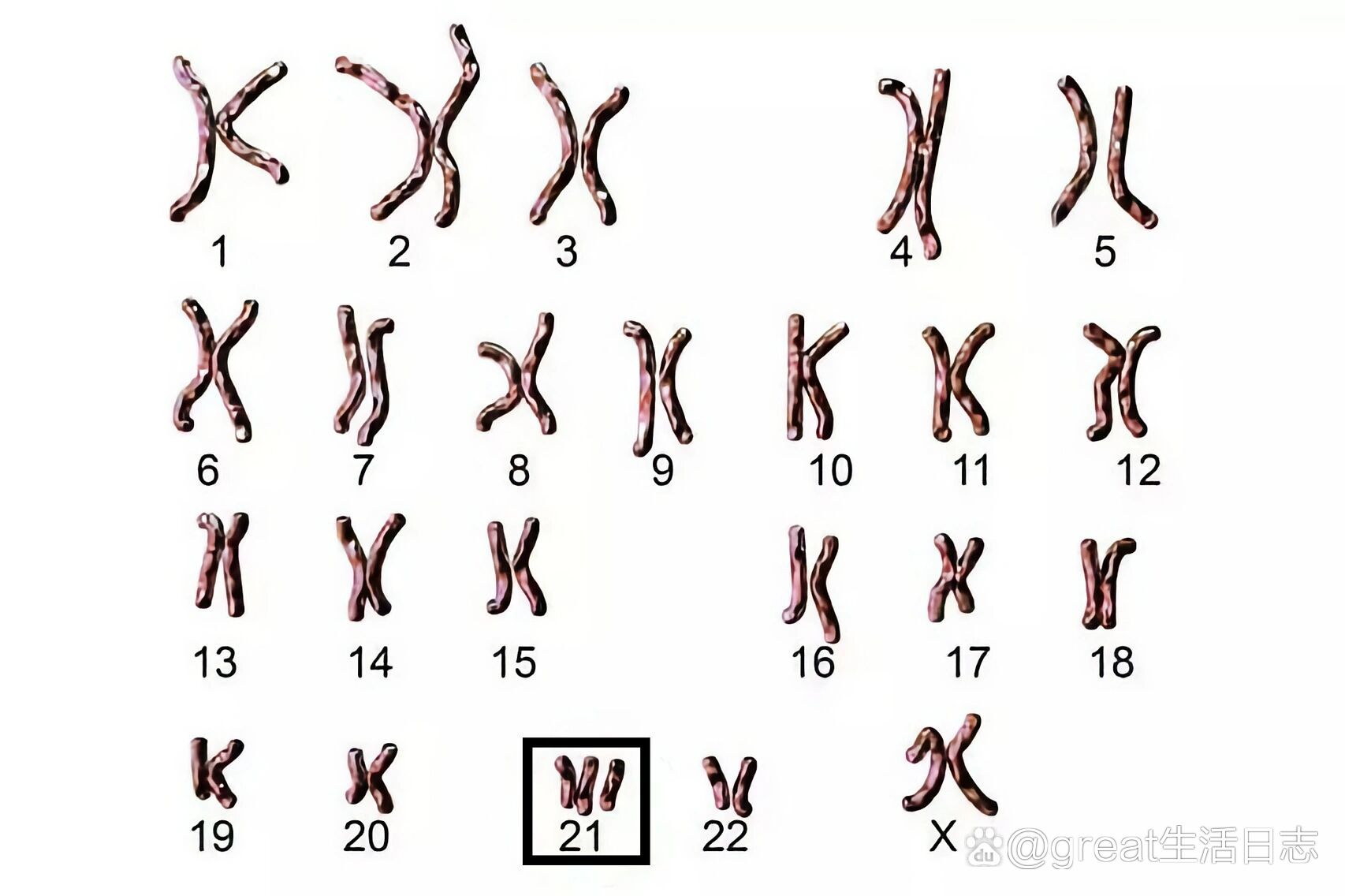 134-常见非整倍体染色体异常遗传病