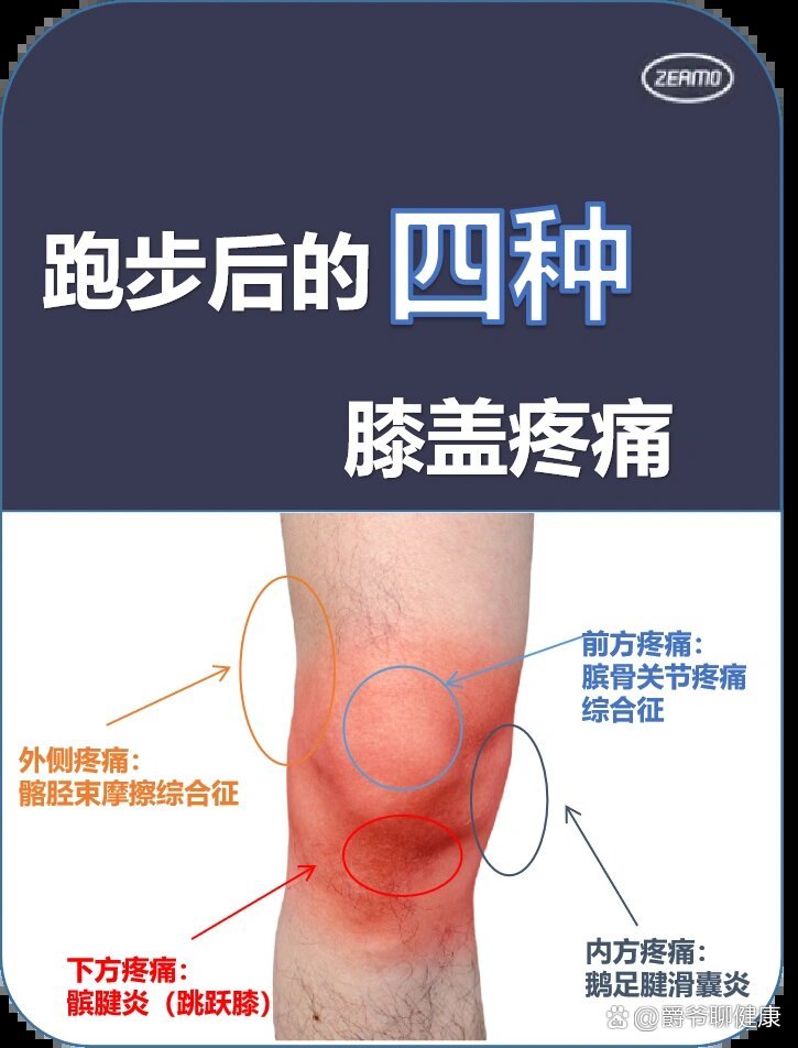 新手必看 跑步常见的膝盖疼痛