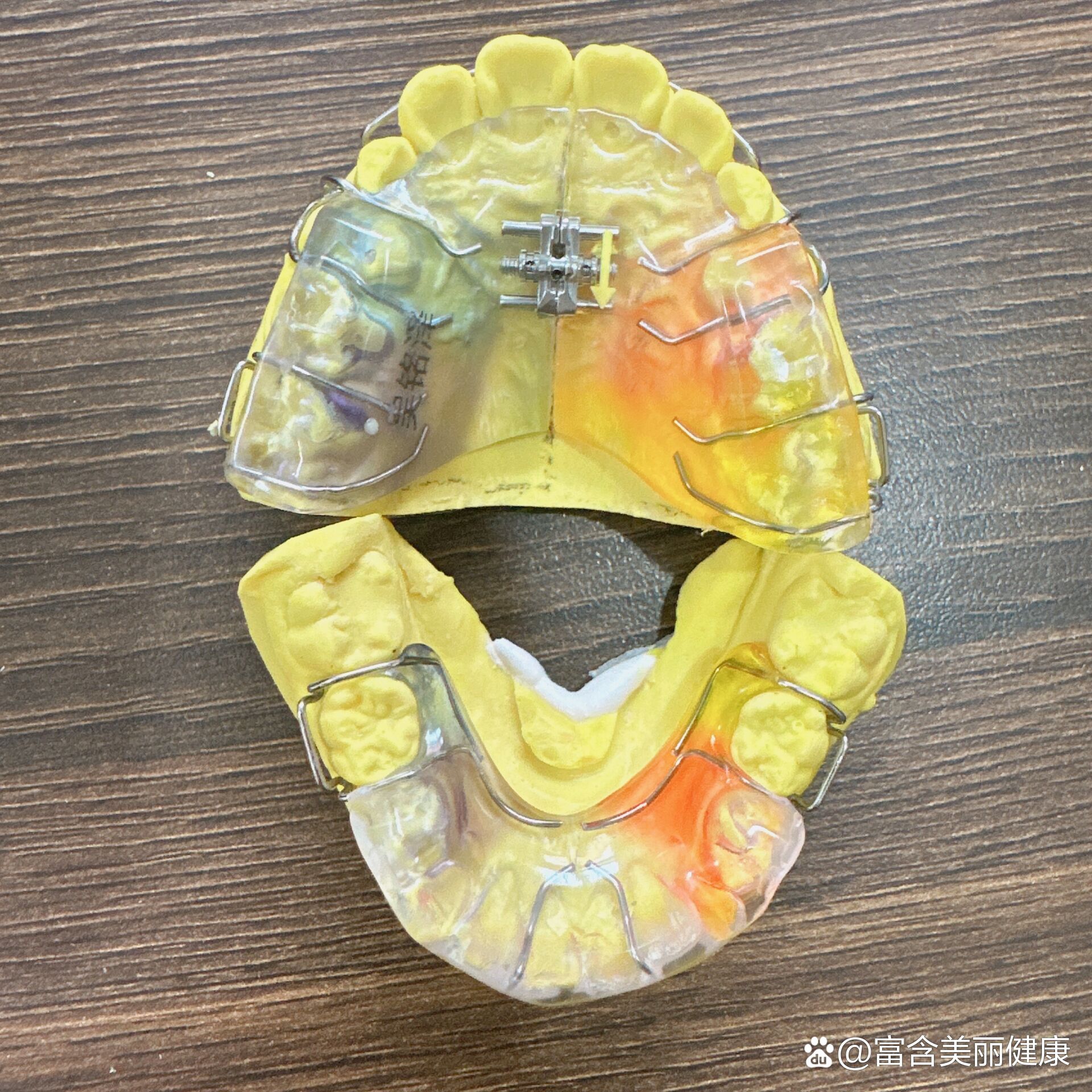 下颌后缩矫治一双颌矫治器