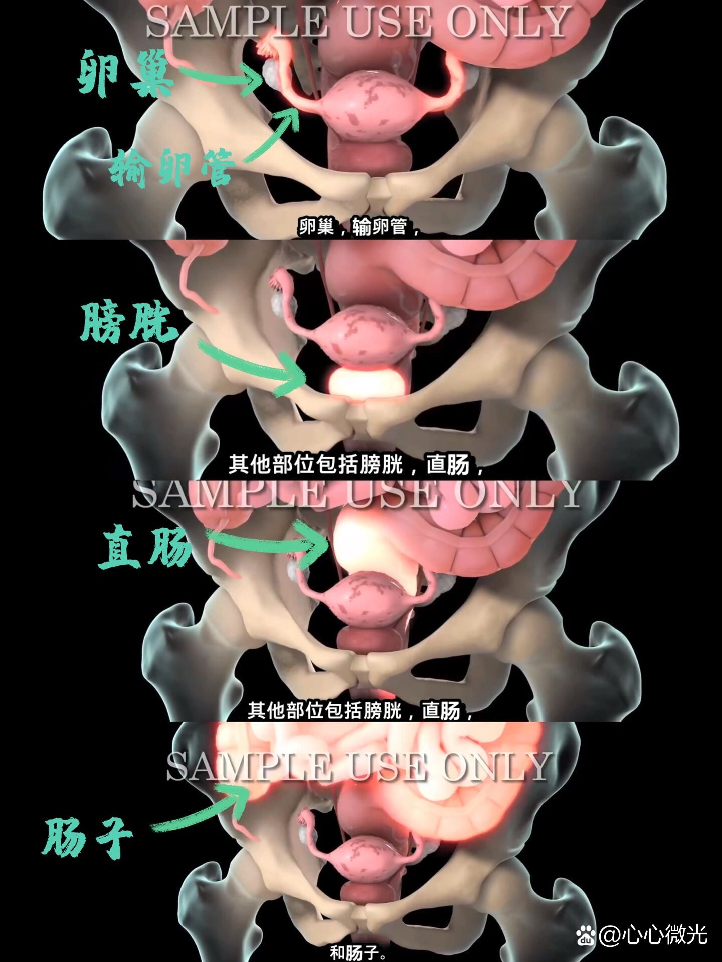 子宫内膜异位症|痛经|妇科病