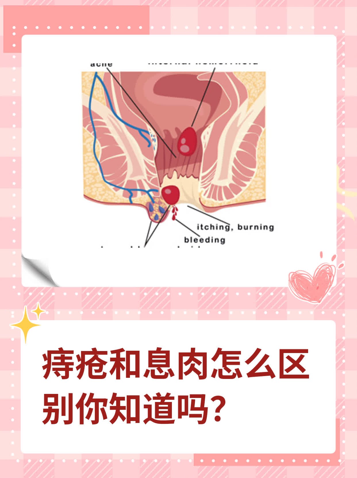 正常肛门和痔疮区别图图片