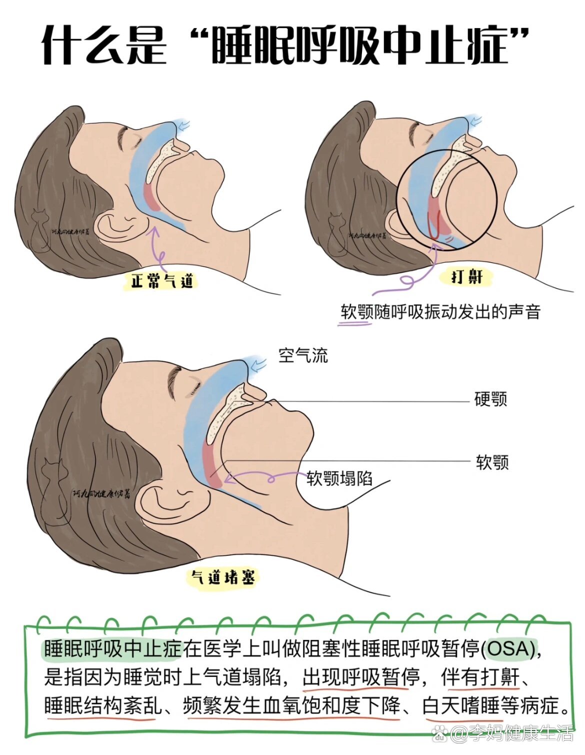 睡眠呼吸暂停综合症的危害