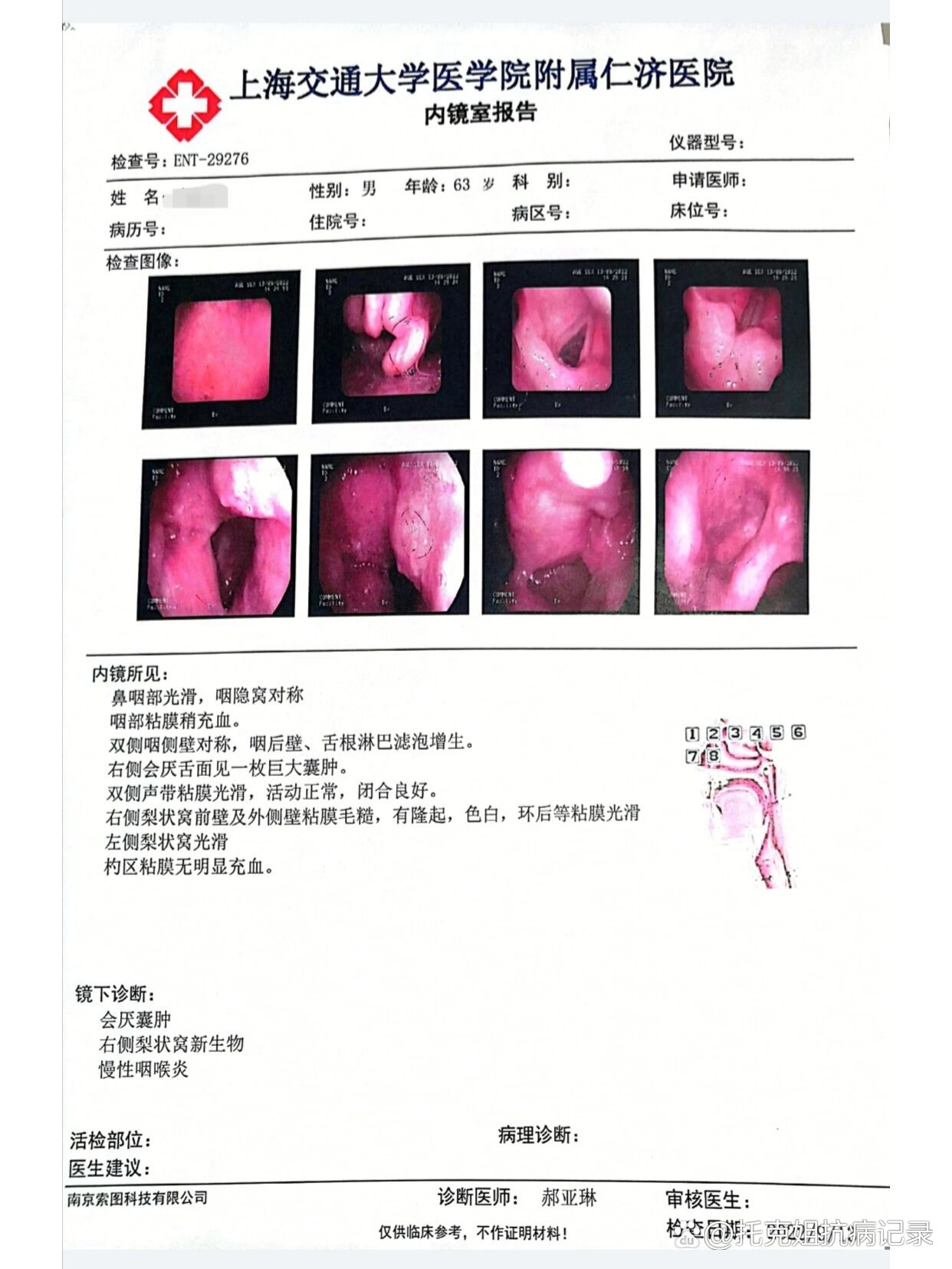 梨状窝癌图片