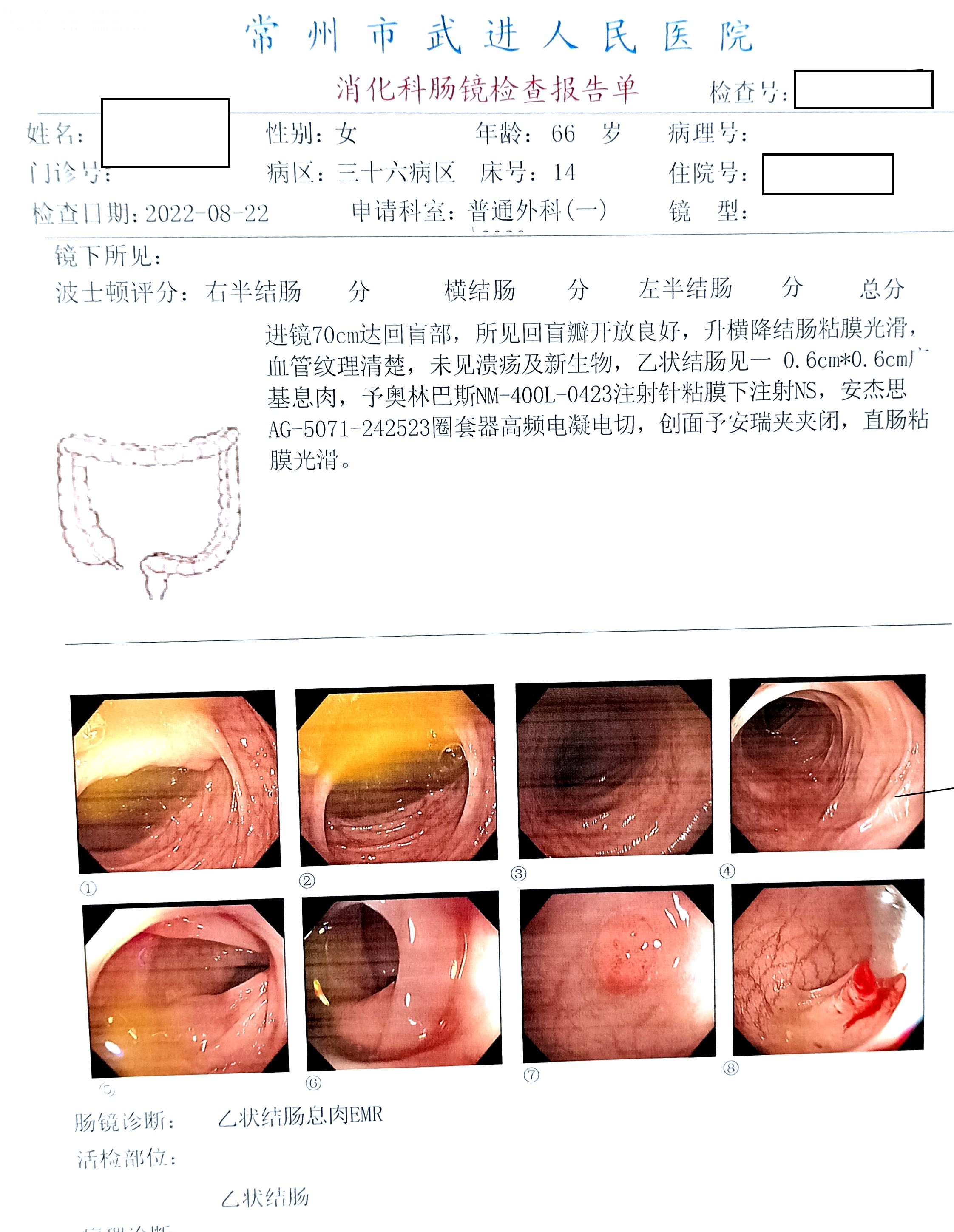 一例乙状结肠腺瘤样息肉行内镜下治疗的诊疗体会