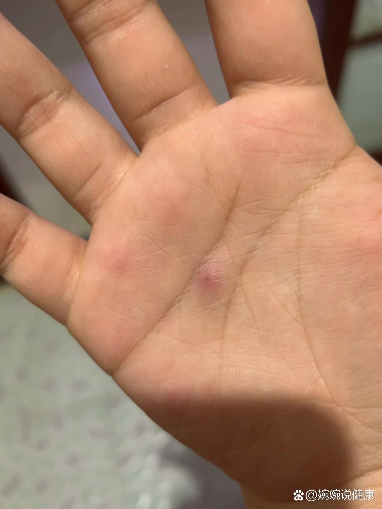 被竹签扎到怎么办
